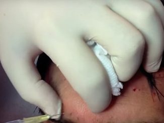 Boom botox e filler per tanti uomini, interventi estetici per 151 mila Tra i trattamenti ci sono tossina botulinica e filler a farla da padrone