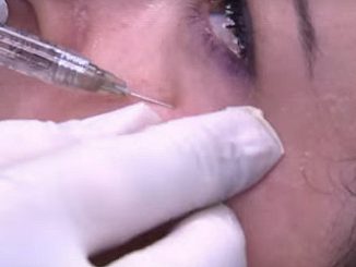ampire Face Lifting per rinfrescare i tratti del volto Iniezioni di sangue venoso prelevato dallo stesso paziente
