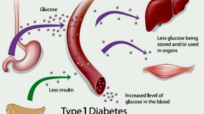 Diabete tipo 1, ricercatori italiani scoprono molecole che innescano malattia