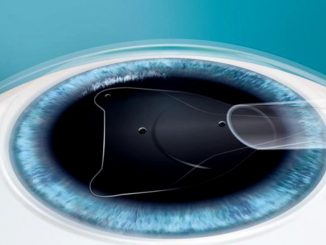 Lenti intraoculari ICL per miopia e ipermetropia avanzate