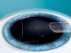 Lenti intraoculari ICL per miopia e ipermetropia avanzate