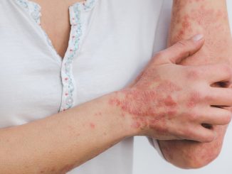 1,8 milioni di italiani affetti da psoriasi, Apiafco intensifica impegno