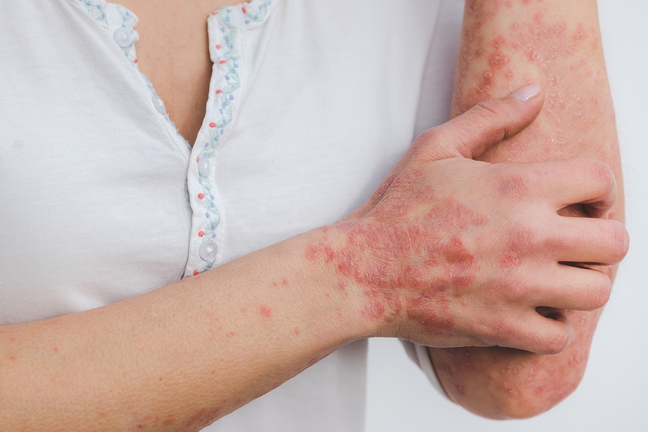 1,8 milioni di italiani affetti da psoriasi, Apiafco intensifica impegno