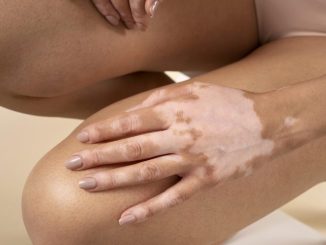 In Italia disponibile il primo farmaco per la vitiligine