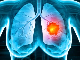 Nuova scoperta sui biomarcatori per il tumore al polmone