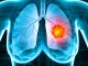 Nuova scoperta sui biomarcatori per il tumore al polmone