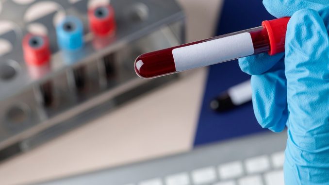 Esame del sangue per la diagnosi precoce del tumore al pancreas
