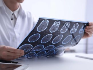Sclerosi multipla, nuovi strumenti per diagnosi più precoci e cure