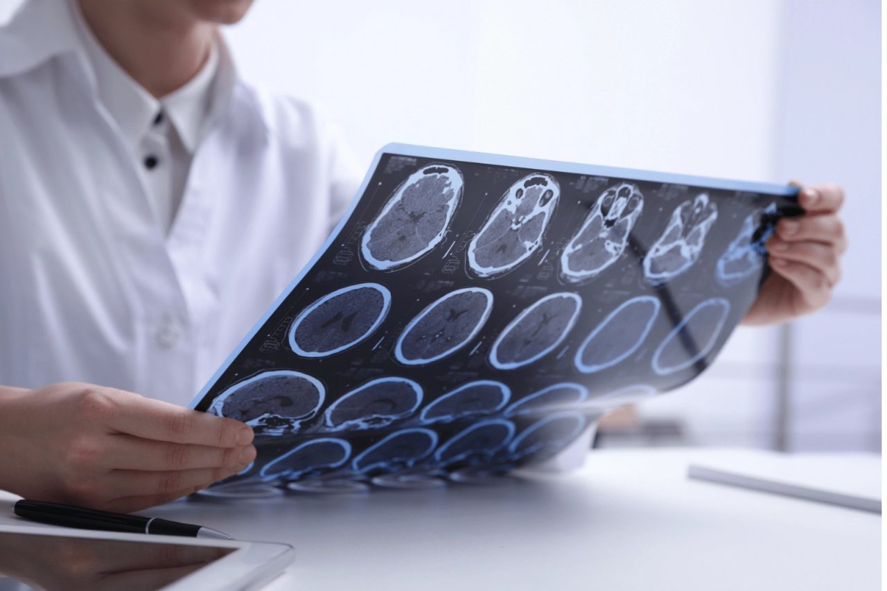 Sclerosi multipla, nuovi strumenti per diagnosi più precoci e cure