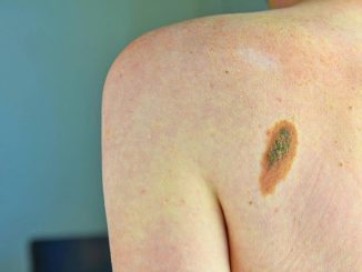 Prevenzione melanoma, Sidemast chiede percorsi chiari e sicuri