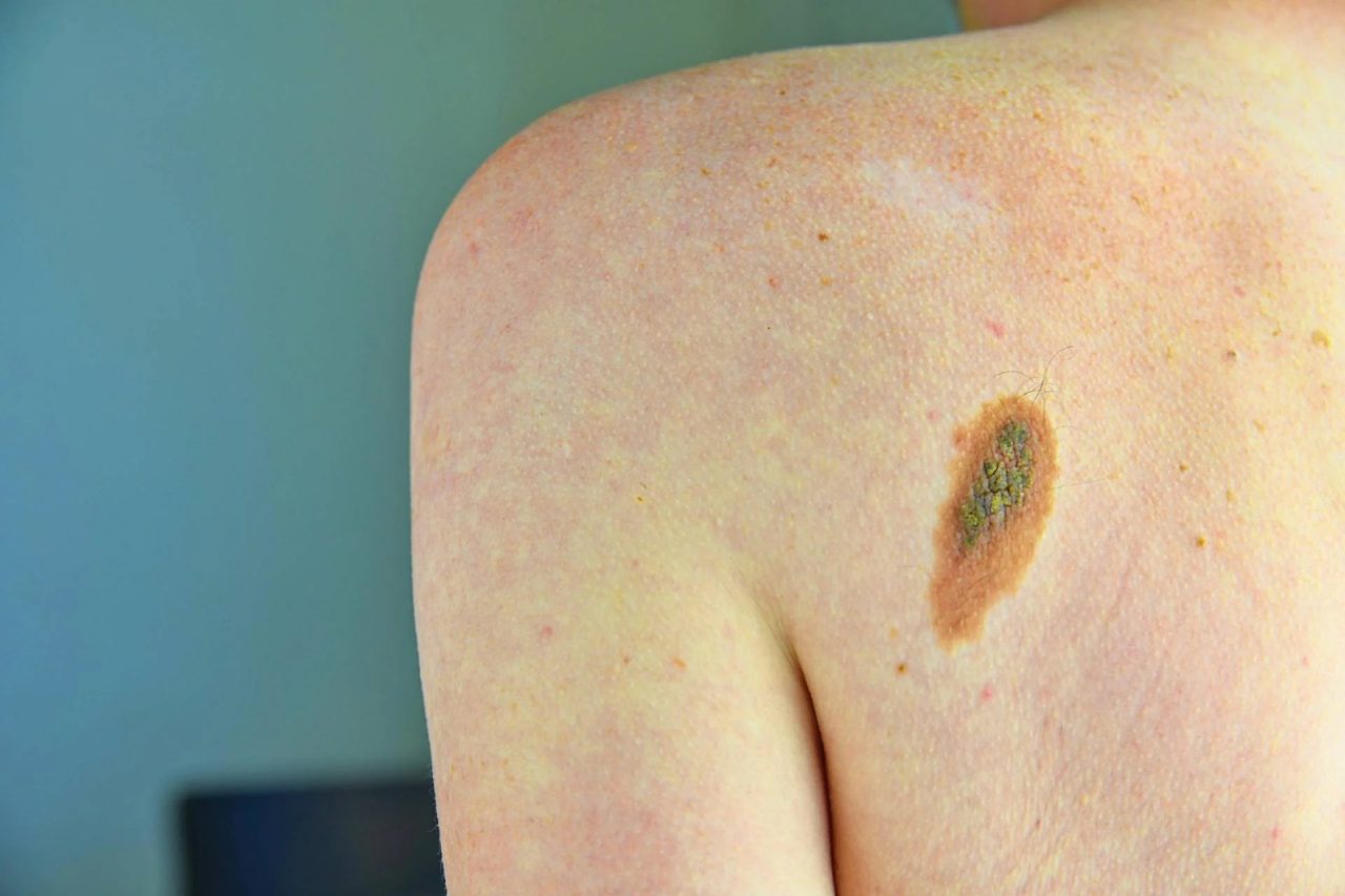 Prevenzione melanoma, Sidemast chiede percorsi chiari e sicuri