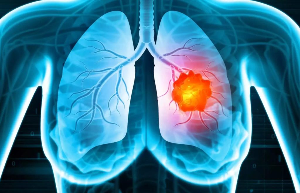 Osimertinib e chemio, nuova speranza nel carcinoma polmonare