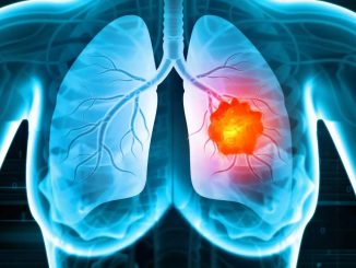 Osimertinib e chemio, nuova speranza nel carcinoma polmonare