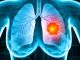 Osimertinib e chemio, nuova speranza nel carcinoma polmonare