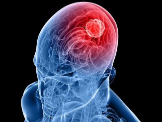 Nuova strategia immunitaria contro il glioblastoma aggressivo