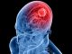 Nuova strategia immunitaria contro il glioblastoma aggressivo