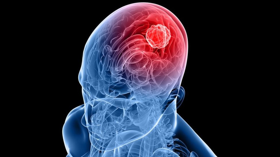 Nuova strategia immunitaria contro il glioblastoma aggressivo