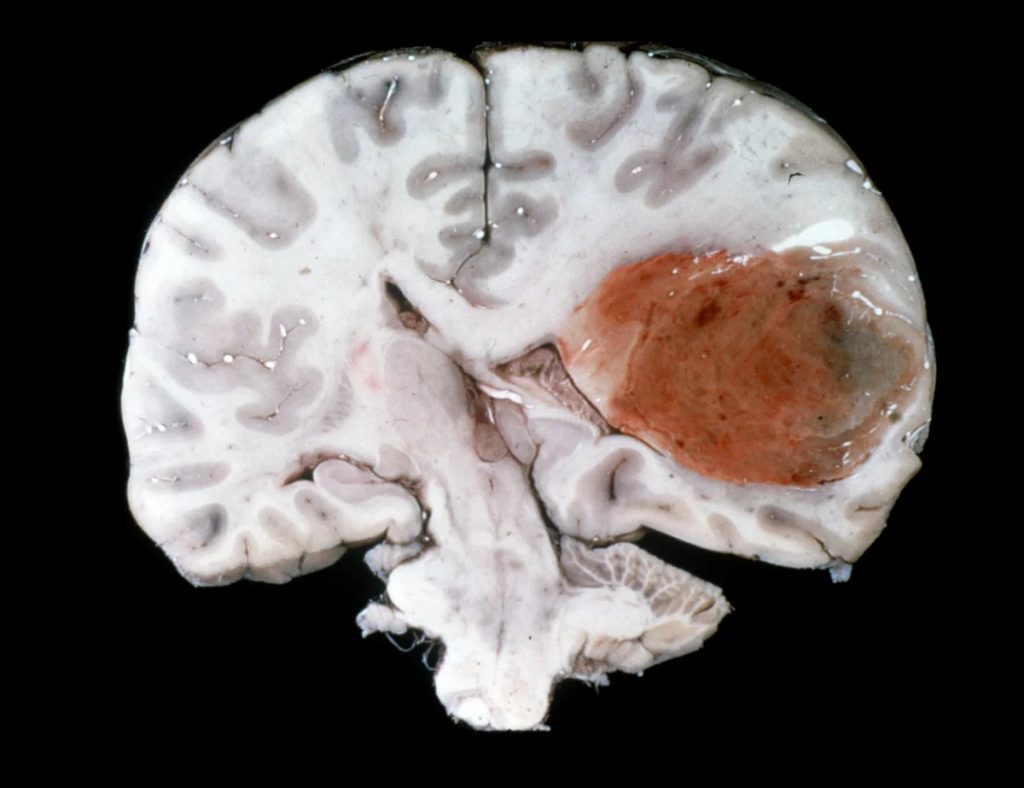 Nuovo anticorpo rallenta il glioblastoma e protegge il cervello