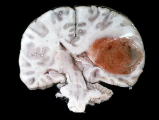 Nuovo anticorpo rallenta il glioblastoma e protegge il cervello