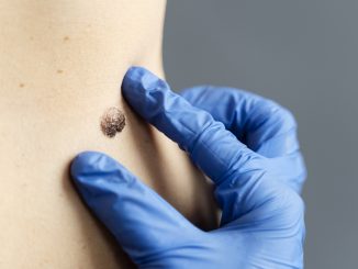 Melanoma: il 70% dei casi nasce da nuove lesioni cutanee