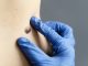 Melanoma: il 70% dei casi nasce da nuove lesioni cutanee