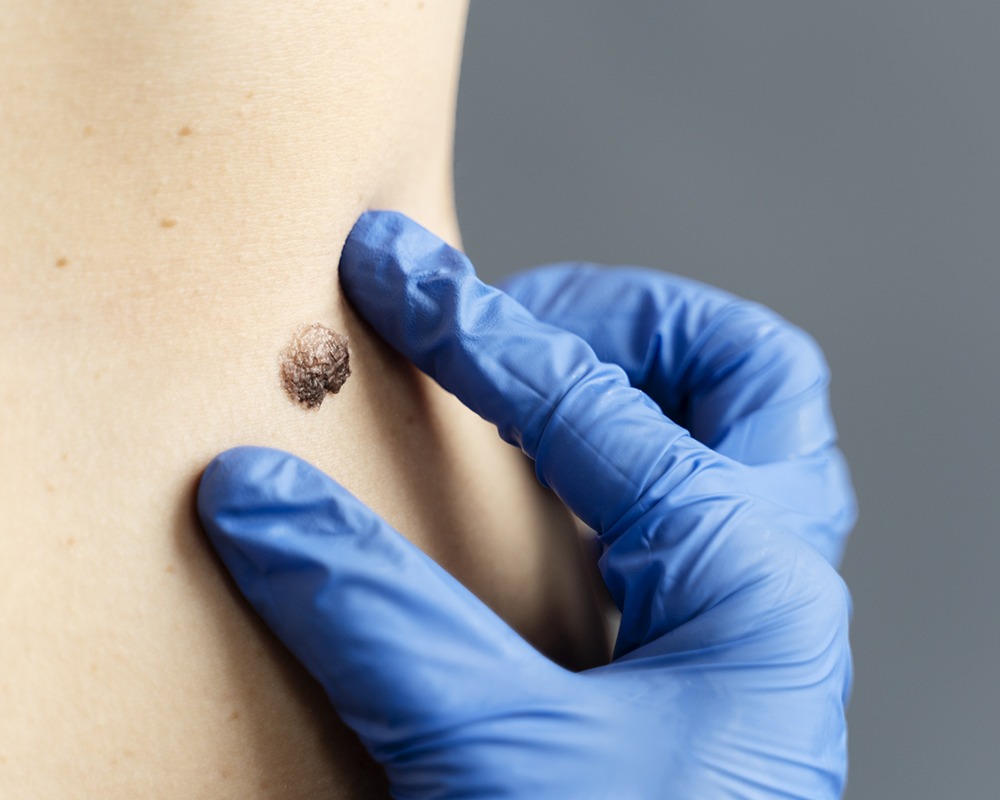 Melanoma: il 70% dei casi nasce da nuove lesioni cutanee
