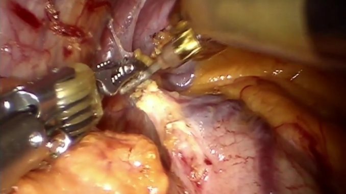 Acalasia esofagea e miotomia per via laparoscopica o robotica integrata
