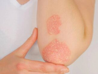 Psoriasi: zasocitinib rivoluziona la cura con dati di fase 3