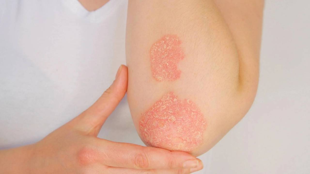 Psoriasi: zasocitinib rivoluziona la cura con dati di fase 3