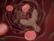 Studio NO-CUT, la biopsia liquida rivoluziona la cura del tumore rettale